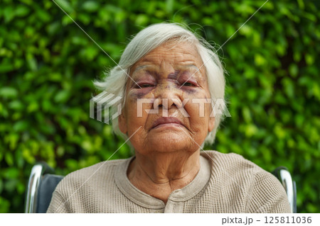 senior woman injury to eyelid and nose swelling from an accident 125811036