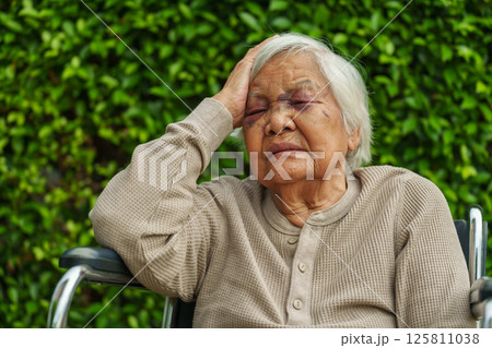 senior woman headache and injury to eyelid and nose swelling from an accident senior woman headache and injury to eyelid and nose swelling from an accident 125811038