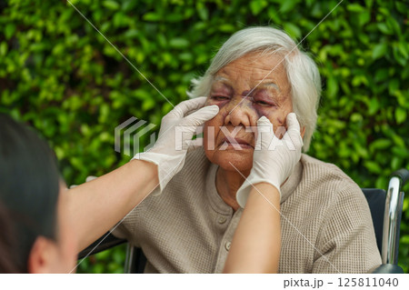Doctor checking senior woman's face and eye with bruise from accident Doctor checking senior woman's face and eye with bruise from accident 125811040