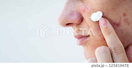 young woman applies acne cream on female face with pimples. Girl with problematic skin in closeup on isolated white background young woman applies acne cream on female face with pimples. Girl with problematic skin in closeup on isolated white background 125819478