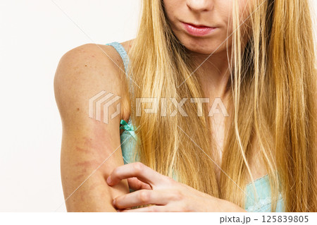 Woman scratching her itchy arm. Skin allergy. 125839805