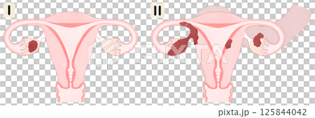 卵巢癌 I 期和 II 期(1 期和 2 期)套裝,簡單易懂的圖表插圖 卵巢癌 I 期和 II 期(1 期和 2 期)套裝,簡單易懂的圖表插圖 125844042