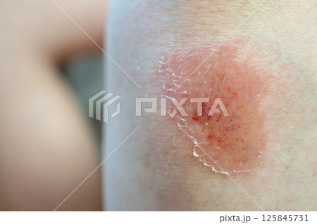 Close-up of healing skin with redness and peeling on caucasian boy Close-up of healing skin with redness and peeling on caucasian boy 125845731