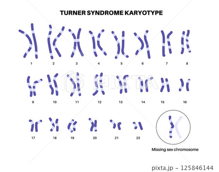 Turner syndrome poster 125846144