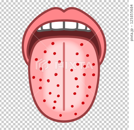 Illustration of a tongue with red eczema, strawberry tongue, and diseased tongue Illustration of a tongue with red eczema, strawberry tongue, and diseased tongue 125855684