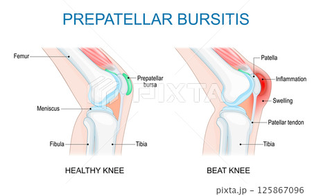 Prepatellar bursitis. Knee joint inflammation 125867096