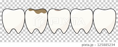 Vector illustration set of tooth with decay Vector illustration set of tooth with decay 125885234