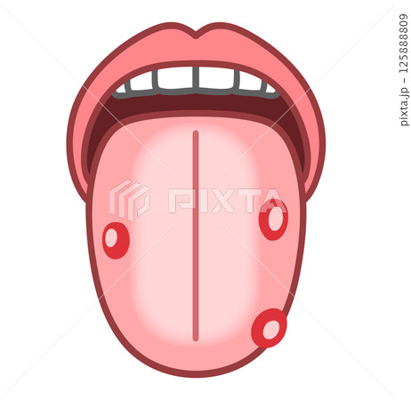 口内炎ができた舌、舌診、病的な舌のイラスト 口内炎ができた舌、舌診、病的な舌のイラスト 125888809