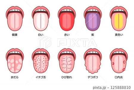 舌診、さまざまな症状の舌 125888810