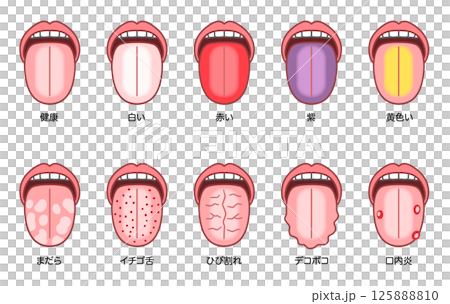 舌診、さまざまな症状の舌 125888810