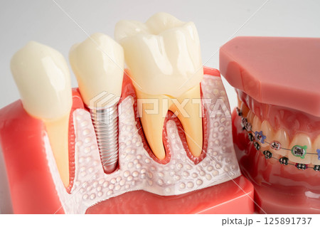 Dental implant, artificial tooth roots into jaw, root canal of dental treatment, gum disease, teeth model for dentist studying about dentistry. 125891737