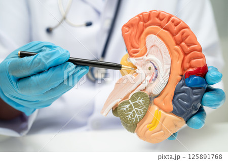 Alzheimer disease, Asian doctor holding brain anatomy model for study diagnosis and treatment in hospital. Alzheimer disease, Asian doctor holding brain anatomy model for study diagnosis and treatment in hospital. 125891768