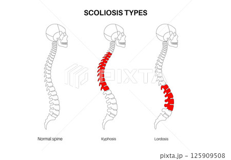 Scoliosis medical poster Scoliosis medical poster 125909508