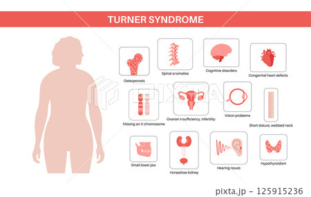 Turner syndrome poster 125915236