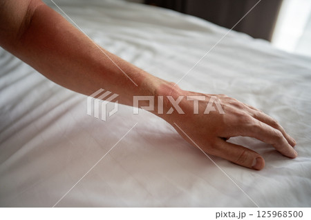 Man sunburned hand on bedsheet, red skin pale watch mark. Sun allergy irritation, UV burning pain Man sunburned hand on bedsheet, red skin pale watch mark. Sun allergy irritation, UV burning pain 125968500