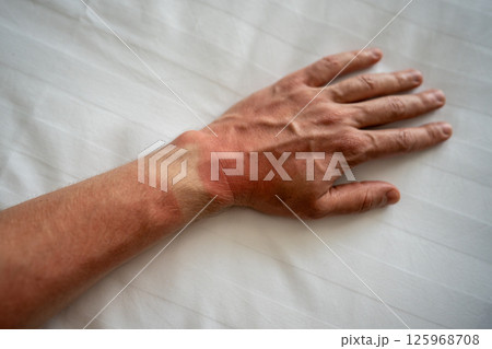 Man sunburned hand on bedsheet, red skin pale watch mark. Sun allergy irritation, UV burning pain Man sunburned hand on bedsheet, red skin pale watch mark. Sun allergy irritation, UV burning pain 125968708