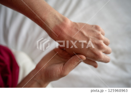 Man hand with sun burn left the mark on wrist watch. Male showing painful skin on arm after sunburn 125968963