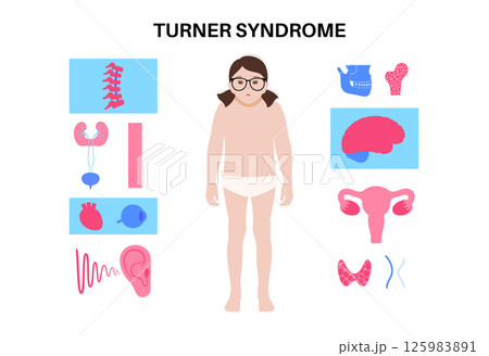 Turner syndrome poster 125983891
