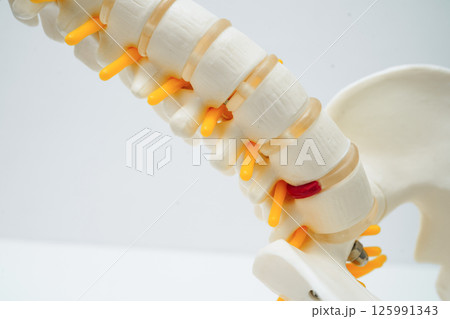 Spinal nerve and bone, Lumbar spine displaced herniated disc fragment, Model for treatment medical in the orthopedic department. Spinal nerve and bone, Lumbar spine displaced herniated disc fragment, Model for treatment medical in the orthopedic department. 125991343