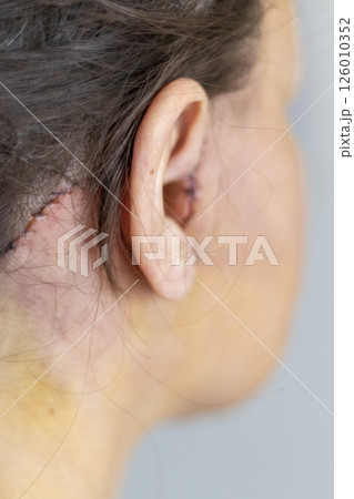 Shot of the stitches and scars on woman head after cosmetic surgery. 126010352