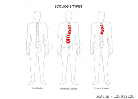 Scoliosis medical poster Scoliosis medical poster 126012120