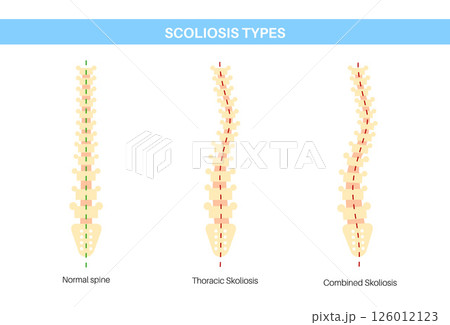 Scoliosis medical poster 126012123