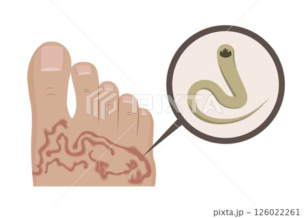 Hookworm causing cutaneous larva migrans infection in human foot 126022261