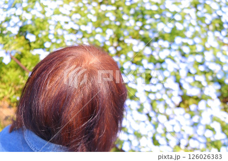 薄毛治療　日本人女性 126026383