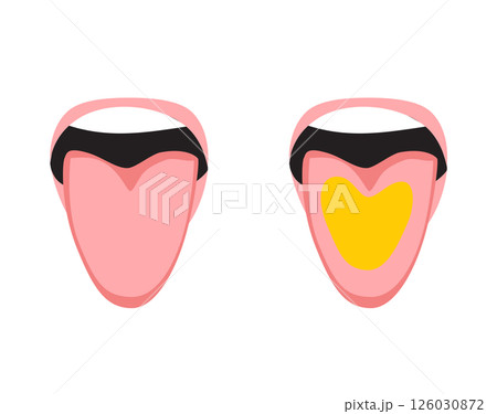 Healthy vs Yellow Coated Tongue Infographic Comparison Cartoon Vector Illustration 126030872