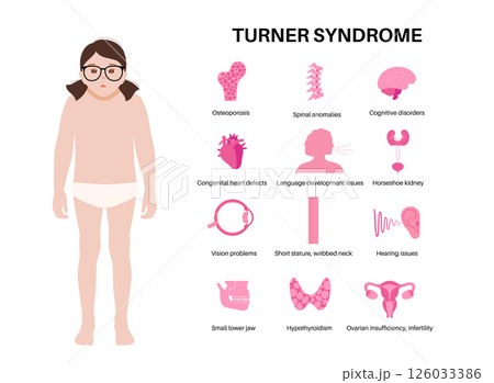 Turner syndrome poster Turner syndrome poster 126033386