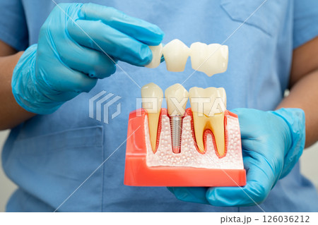 Dental implant, artificial tooth roots into jaw, root canal of dental treatment, gum disease, teeth model for dentist studying about dentistry. Dental implant, artificial tooth roots into jaw, root canal of dental treatment, gum disease, teeth model for dentist studying about dentistry. 126036212