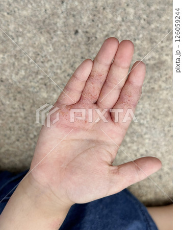湿疹が出た子供の手の平 126059244