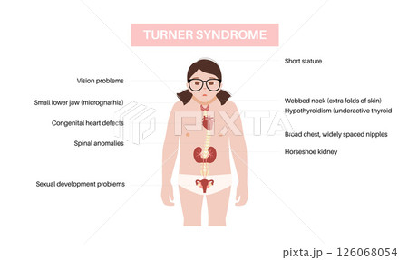 Turner syndrome poster 126068054
