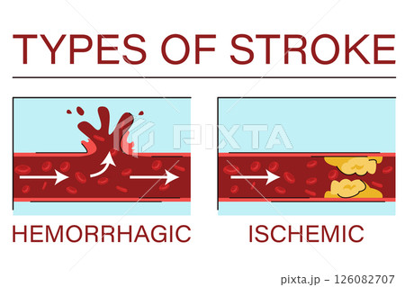 Types of brain stroke vector isolated Types of brain stroke vector isolated 126082707