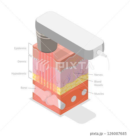 3D Isometric Flat Illustration of Laser Therapy, Alleviating Patient Pain And Stimulate Healing 3D Isometric Flat Illustration of Laser Therapy, Alleviating Patient Pain And Stimulate Healing 126087685