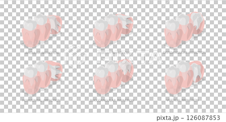 3D Isometric Flat  Illustration of Wisdoms Teeth Dental Problem, Orthodontic and Dentistry 126087853