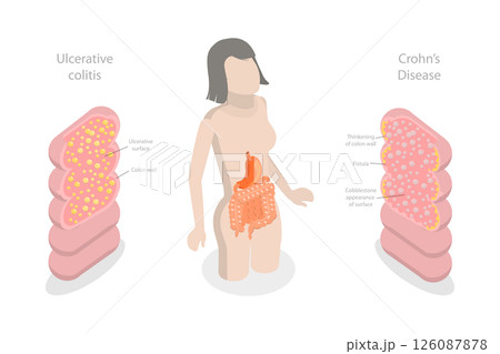 3D Isometric Flat Illustration of IBD, Educational Diagram for Inflammatory Bowel Disease 3D Isometric Flat Illustration of IBD, Educational Diagram for Inflammatory Bowel Disease 126087878
