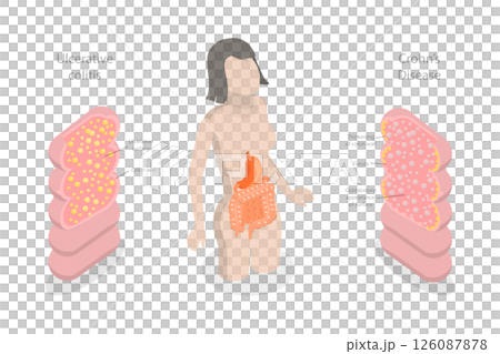 3D Isometric Flat Illustration of IBD, Educational Diagram for Inflammatory Bowel Disease 3D Isometric Flat Illustration of IBD, Educational Diagram for Inflammatory Bowel Disease 126087878
