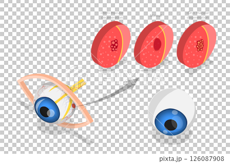 3D Isometric Flat  Illustration of Age-related Macular Degeneration, Eye Illness, Sight Problem 126087908