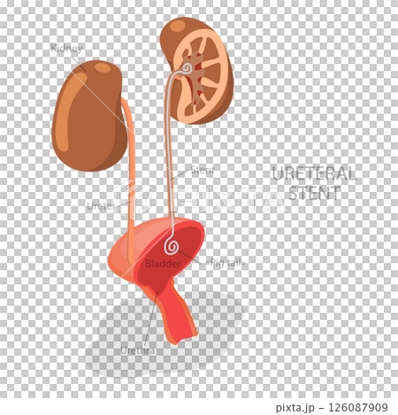 3D Isometric Flat  Illustration of Ureteral Stent, Treatment For Kidney Stones 126087909