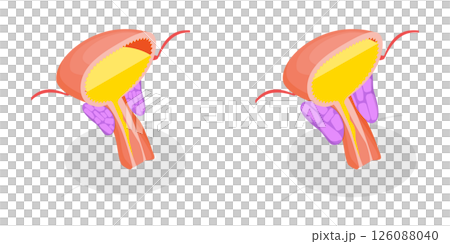 3D Isometric Flat Illustration of Enlarged Prostate Gland, Benign Prostatic Hyperplasia 3D Isometric Flat Illustration of Enlarged Prostate Gland, Benign Prostatic Hyperplasia 126088040