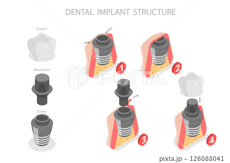 3D Isometric Flat  Illustration of Dental Implant Structure, Key Components And Functionality 126088041