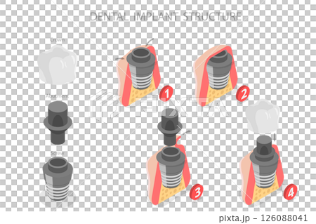 3D Isometric Flat  Illustration of Dental Implant Structure, Key Components And Functionality 126088041