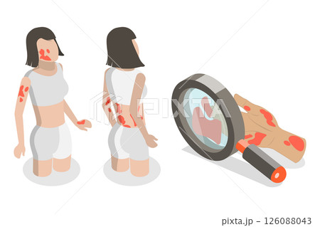 3D Isometric Flat  Illustration of Atopic Dermatitis, Person With Eczema Scratches Itchy Skin 126088043