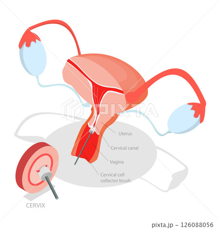 3D Isometric Flat  Illustration of Pap Test, Process Of Conducting A Pap Testing To Detect Abnormal Cells In The Cervix 126088056