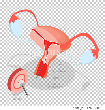3D Isometric Flat  Illustration of Pap Test, Process Of Conducting A Pap Testing To Detect Abnormal Cells In The Cervix 126088056