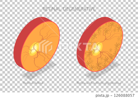 3D Isometric Flat  Illustration of Retinal Degenerative , Vision Impairment, Blind Spots 126088057