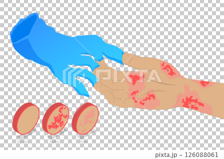 3D Isometric Flat  Illustration of Latex Allergy, Skin Reactions From Chemical Exposure 126088061