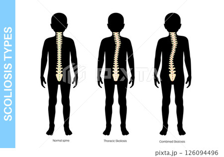 Scoliosis medical poster Scoliosis medical poster 126094496