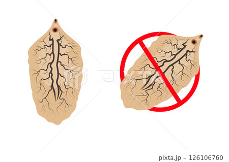 Liver fluke and stop sign representing prevention and treatment of fascioliasis 126106760